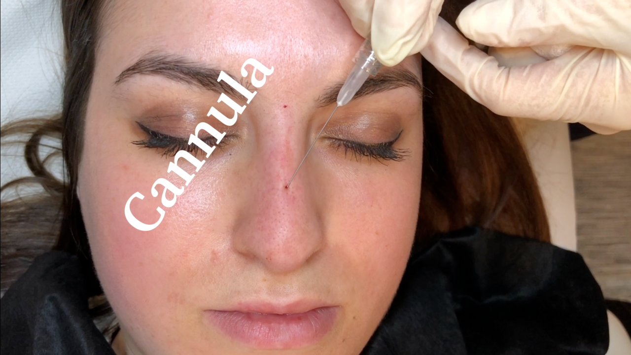 27 gauge cannula needle for injecting dermal filler