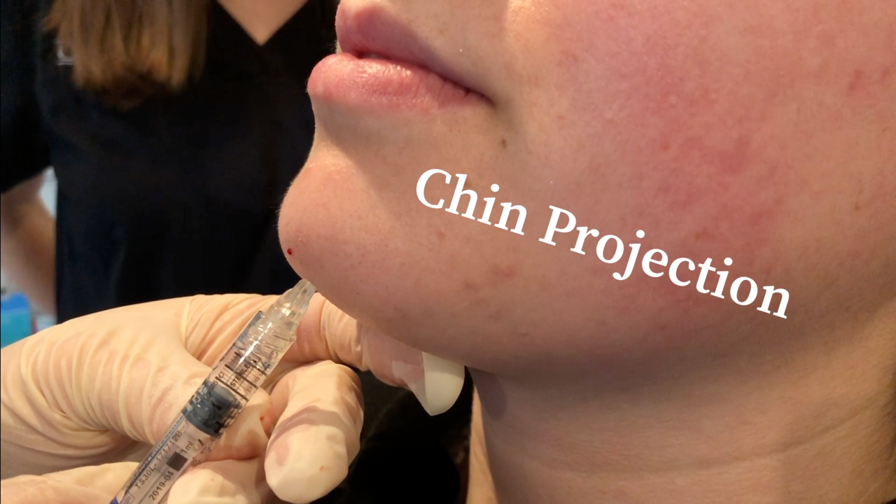 Chin Projection