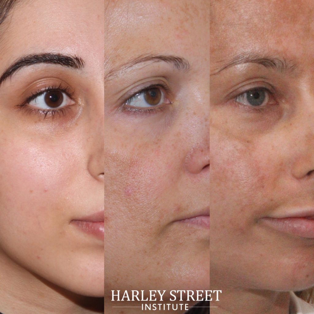 hyperpigmentation on skin surface
