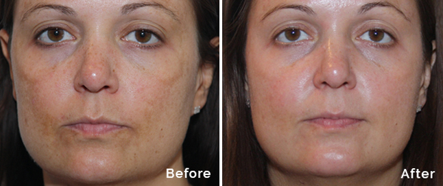 Pigmented skin treatment with peel to reveal befor and after