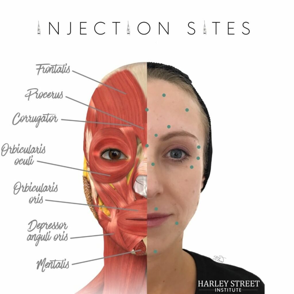 Botox injection sites during Botox training and hands on learning course